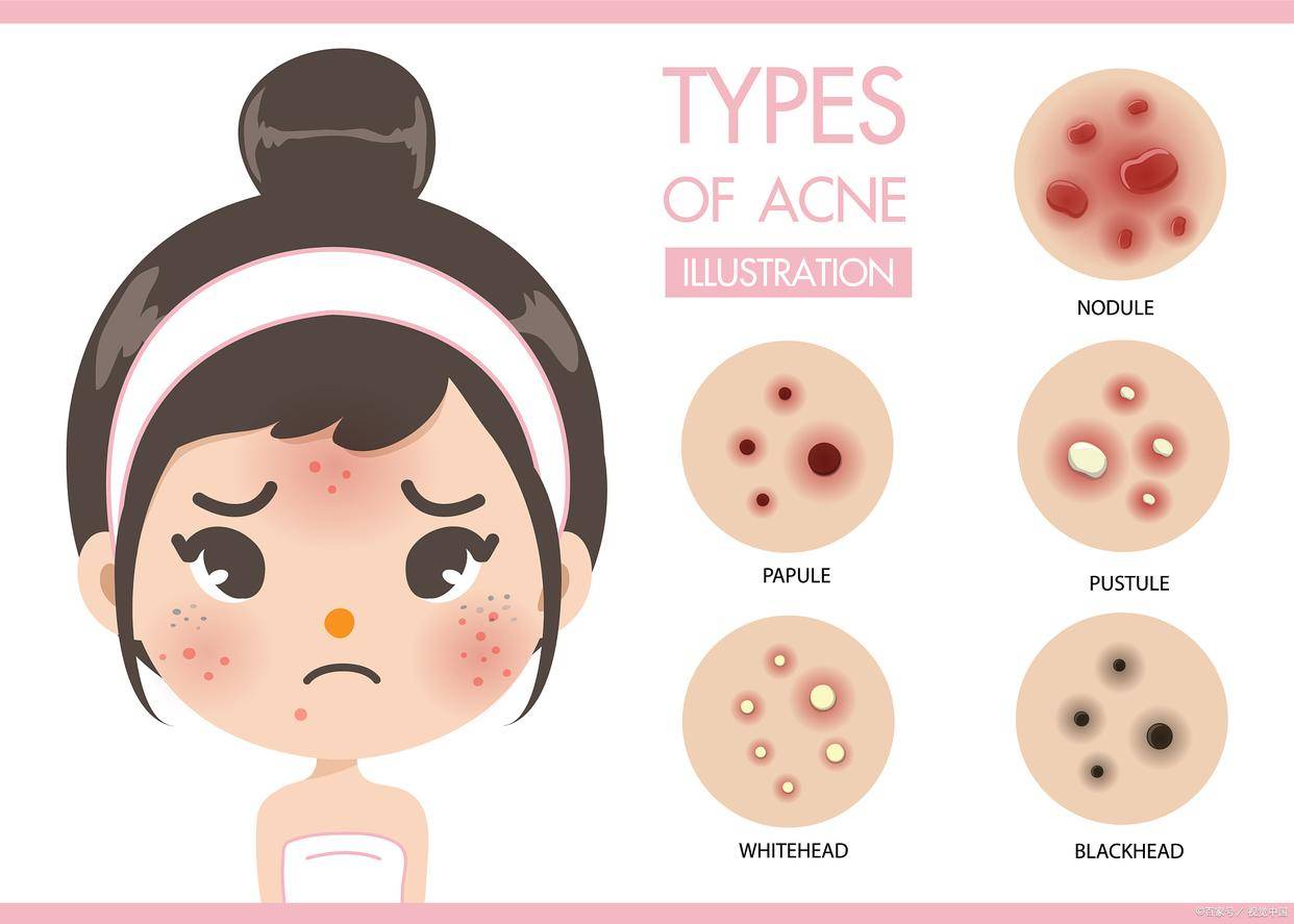 毛孔堵塞时,应该如何处理呢?塑颜工匠生活小常识