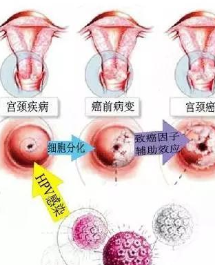 宫颈癌月经图片