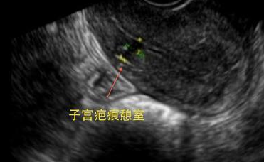 這麼多女明星選擇剖宮產,可能是她們不知道疤痕子宮多