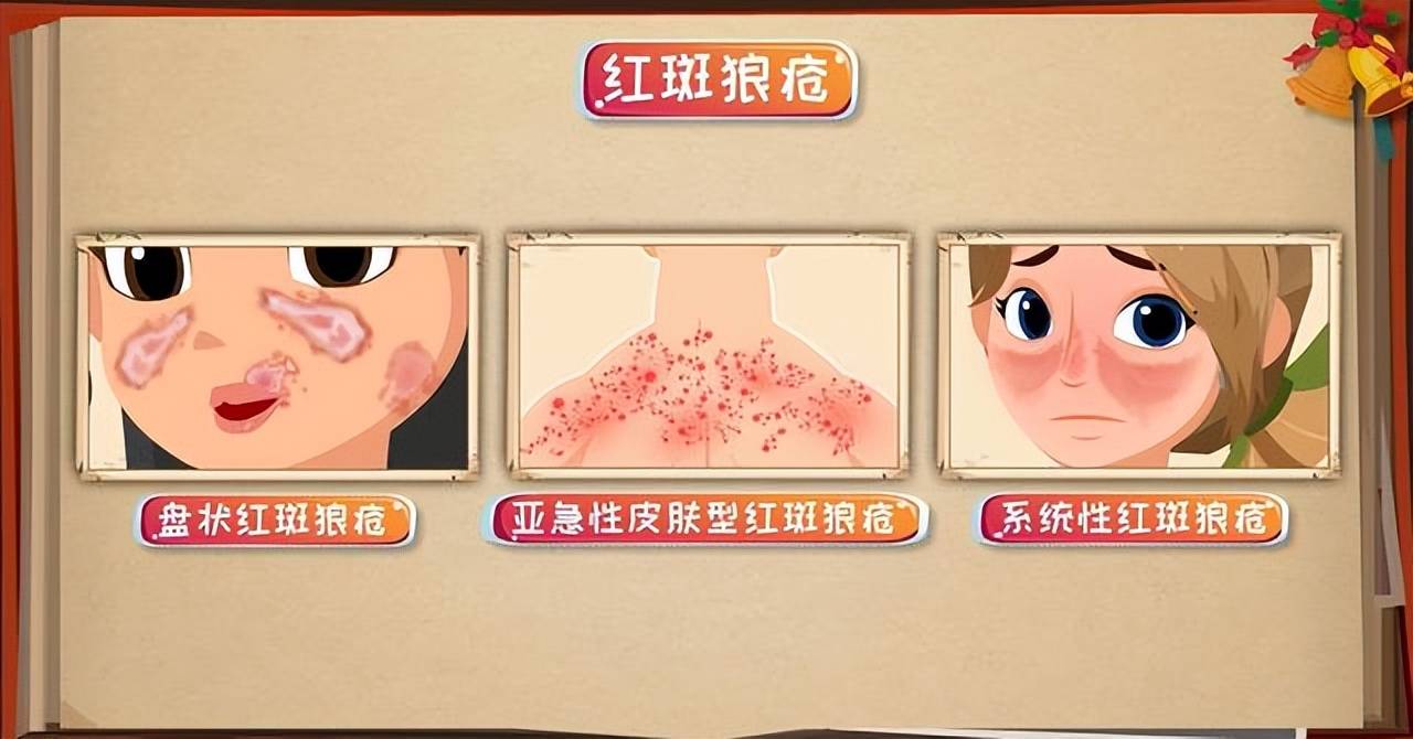 红斑狼疮与温阳祛痹方剂:探索中医治疗之道_患者_方法_病情