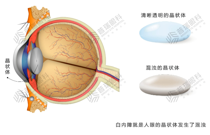 你属于白内障高发人群吗?济南普瑞眼科提醒_晶状体_眼睛_老年人