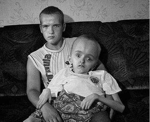 日本_辐射_小男孩