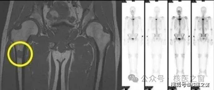 03病理性骨折,被肿瘤侵蚀的骨组织硬度降低,轻微外伤甚至无任何诱因