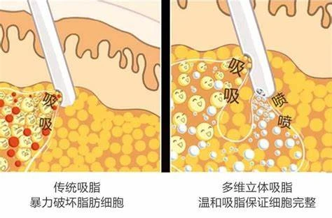 后遗症并非每个患者都会经历,大多数人都能够安全地进行抽脂手术并