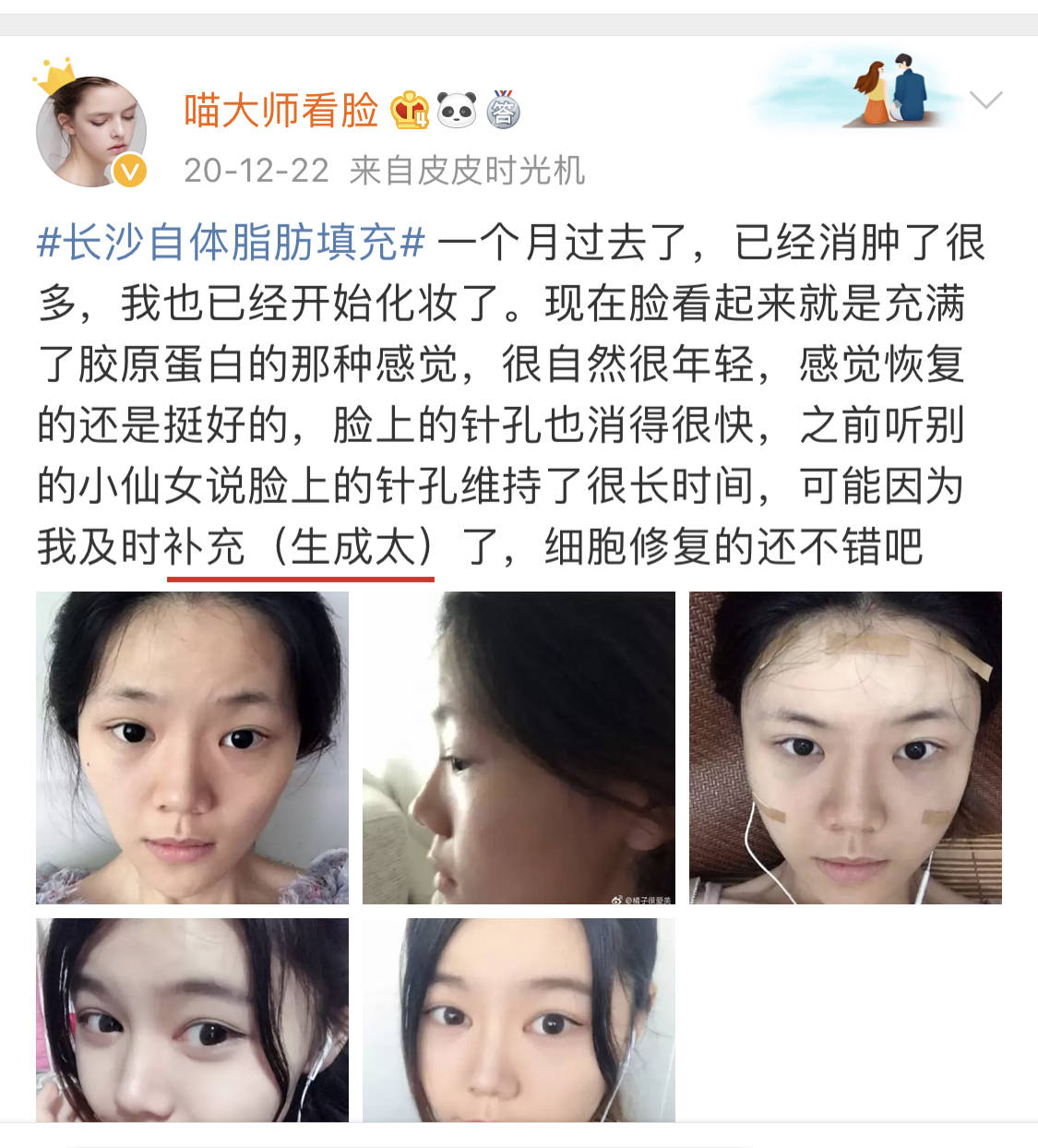 做过手术的过来讲讲自体脂肪隆胸5年后会如何,脂肪抽脂丰胸好么_细胞