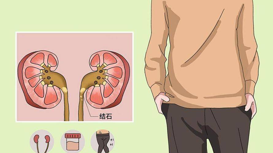 泌尿结石的危害不仅仅是疼痛_典型_膀胱_尿道