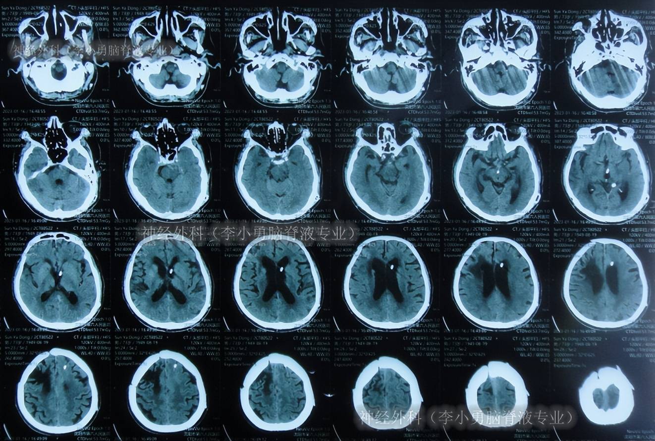 脑囊虫手术37年后的2年半中,脑积水分流术感染脑脊液内有6种细菌_治疗