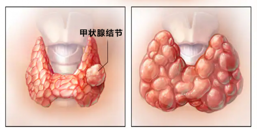 小叶中心结节示意图图片