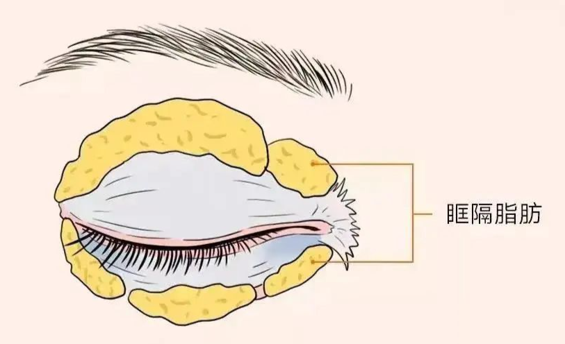 辽宁杏林:祛眼袋哪种方法好?_脂肪_皮肤_下眼睑