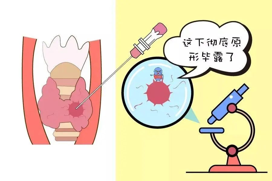 西安甲康甲状腺医院张新亮医生科普:什么时候需要做甲状腺结节穿刺