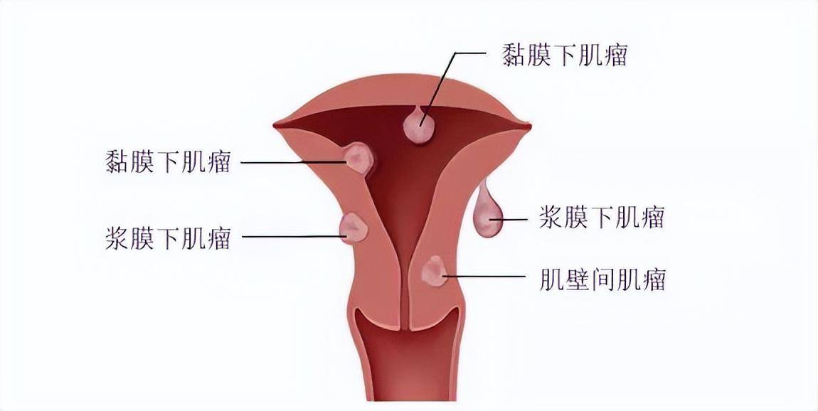 子宫肌瘤"偏爱"同一类女性,媤润告诉你,她们大多有这个特点