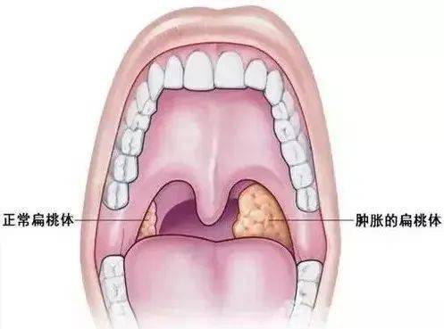 人的舌头会厌部图片图片