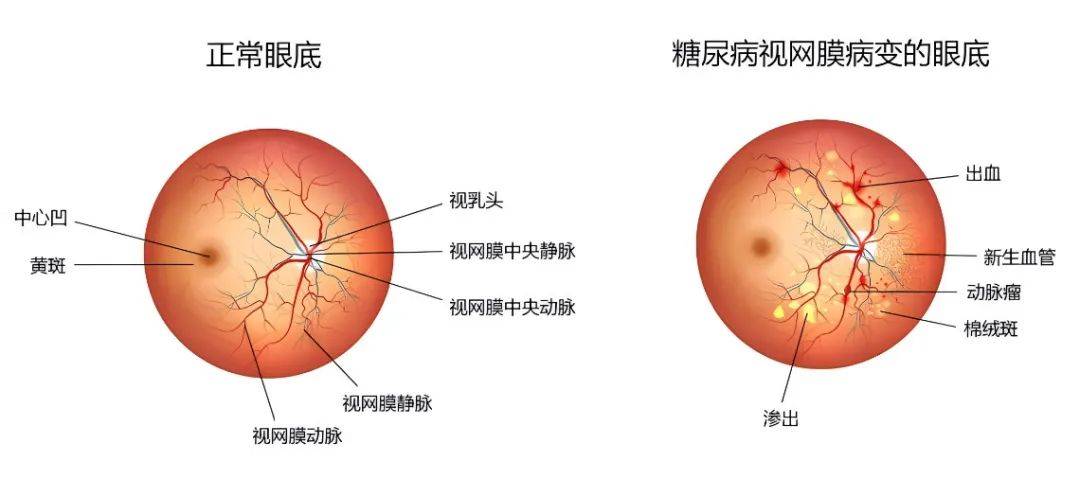 中医调治糖尿病视网膜病变