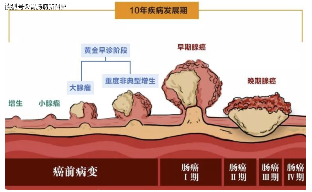 直肠腺癌早中晚期图片图片