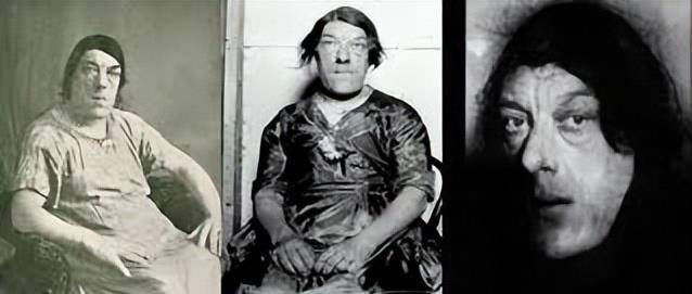 虽然在21世纪的今天,肢端肥大症已经不是什么疑难杂症了,但是在科学尚