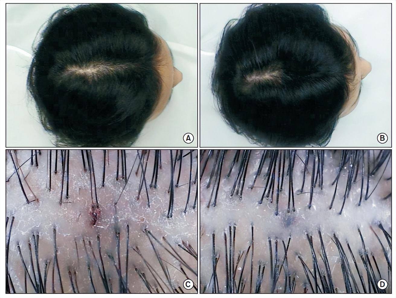 c)和最后一次铥激光治疗后一周(b,d)v点头发的数字图像图4 激光和