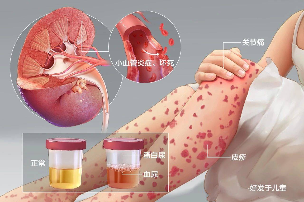过敏性紫癜久了就会成肾炎?这是真的吗?_患者_肾脏_病情