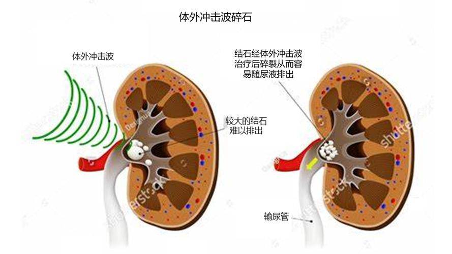体外冲击波碎石,为什么有些结石碎不掉,反而碎坏了