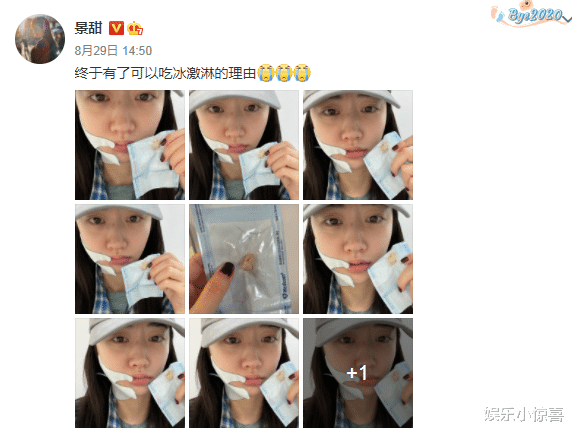 景甜拔智齿后晒素颜照,脸部浮肿气色憔悴,鼻梁处疤痕明显_景甜来_众人