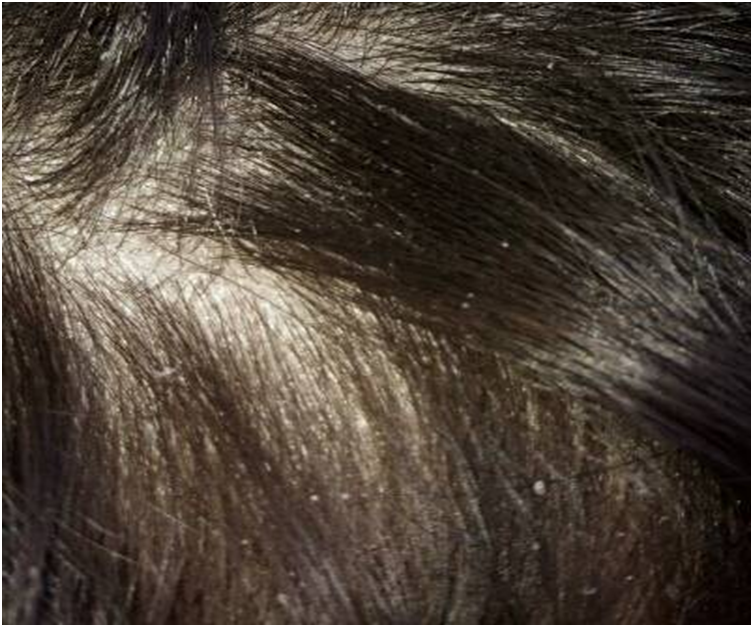 4,内分泌不正常等因素;3,头皮上的皮脂过多,易滋生细菌;2,使用脱脂力