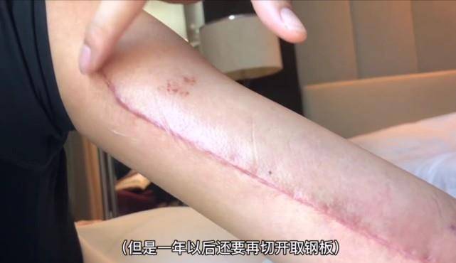 万茜骨折恢复速度快被称"医学奇迹",撕开遮挡物后长伤疤触目惊心_受伤