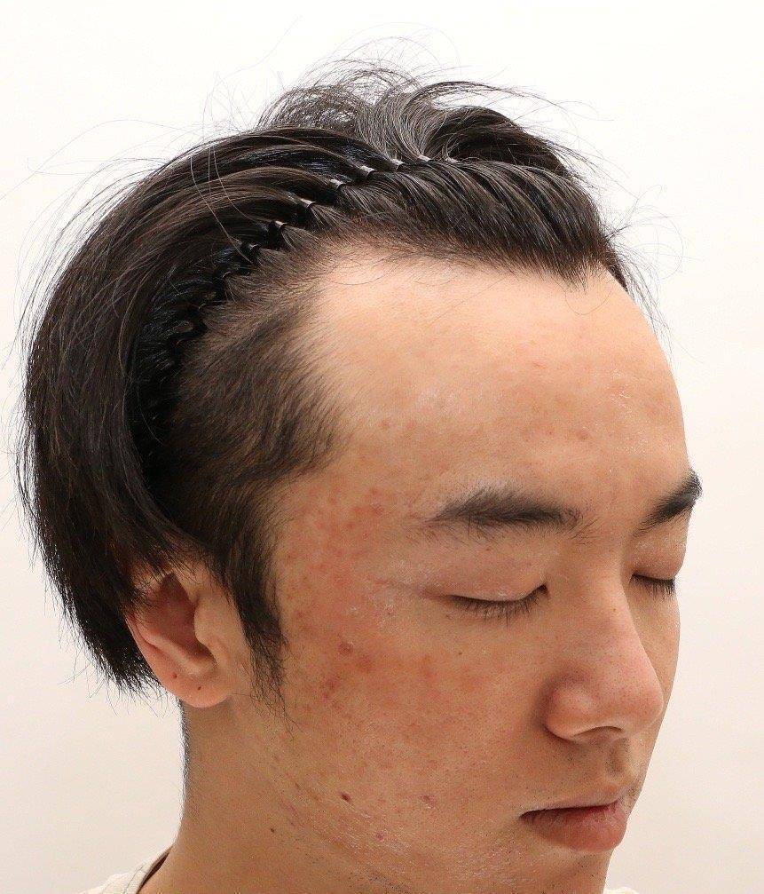 确实做了植发手术,之前的发际线对比也是非常强烈,发际线就像四五十岁