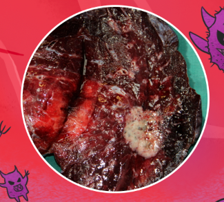 长期咳嗽不一定是感冒_症状_癌症_恶性肿瘤