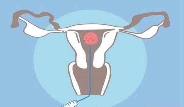 月经周期而剥落,但在腺肌症患者中,子宫内膜异位生长,导致子宫壁增厚