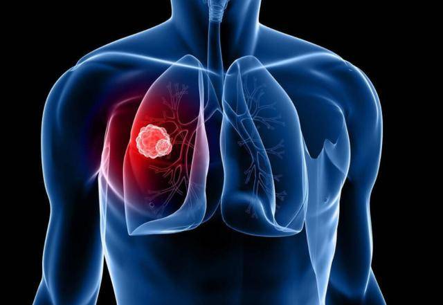 然而,了解哪些结节有癌变的风险,可以帮助我们更好地进行预防和早期