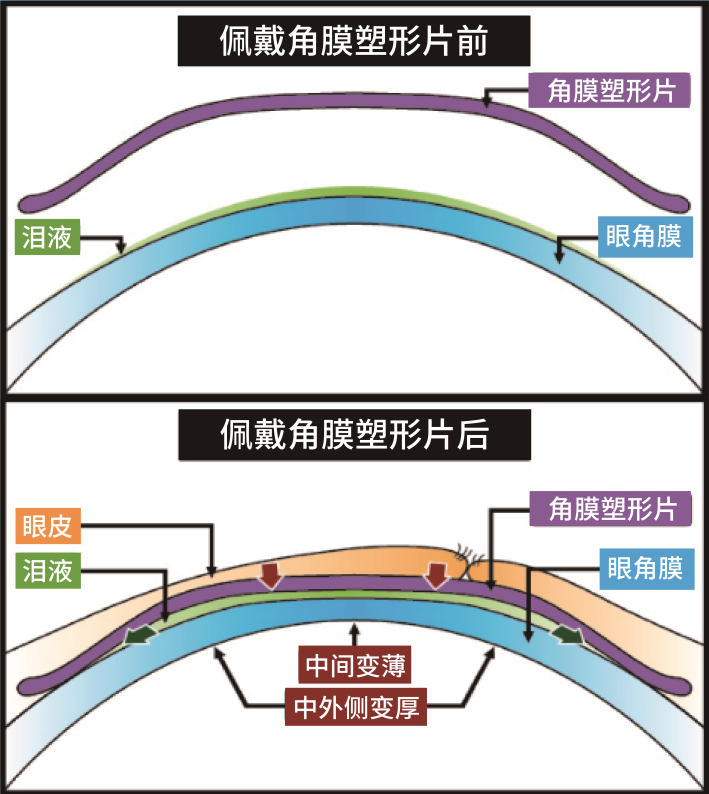 近视离焦镜是一种周边近视离焦原理设计的框架镜片,配戴该镜片后,物体