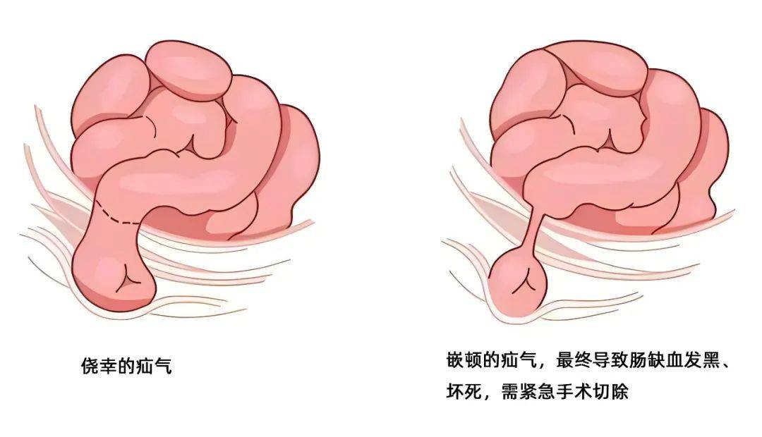 疝气到底是个什么气?一文带你秒懂"疝"_治疗_疾病_手术