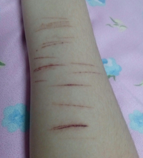 为逃避开学,14岁女孩竟用刀割手自残