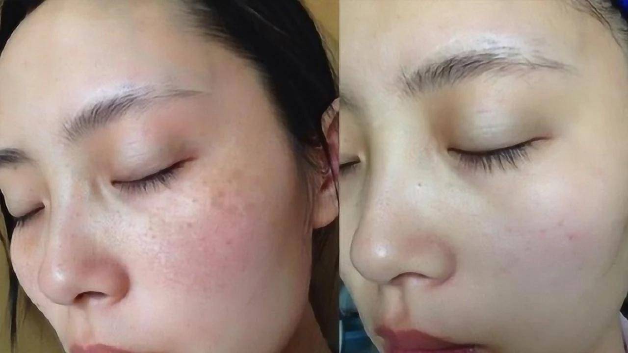 祛斑效果最好的排名第一,淡斑护肤品哪款好用?_成分_皮肤_肌肤