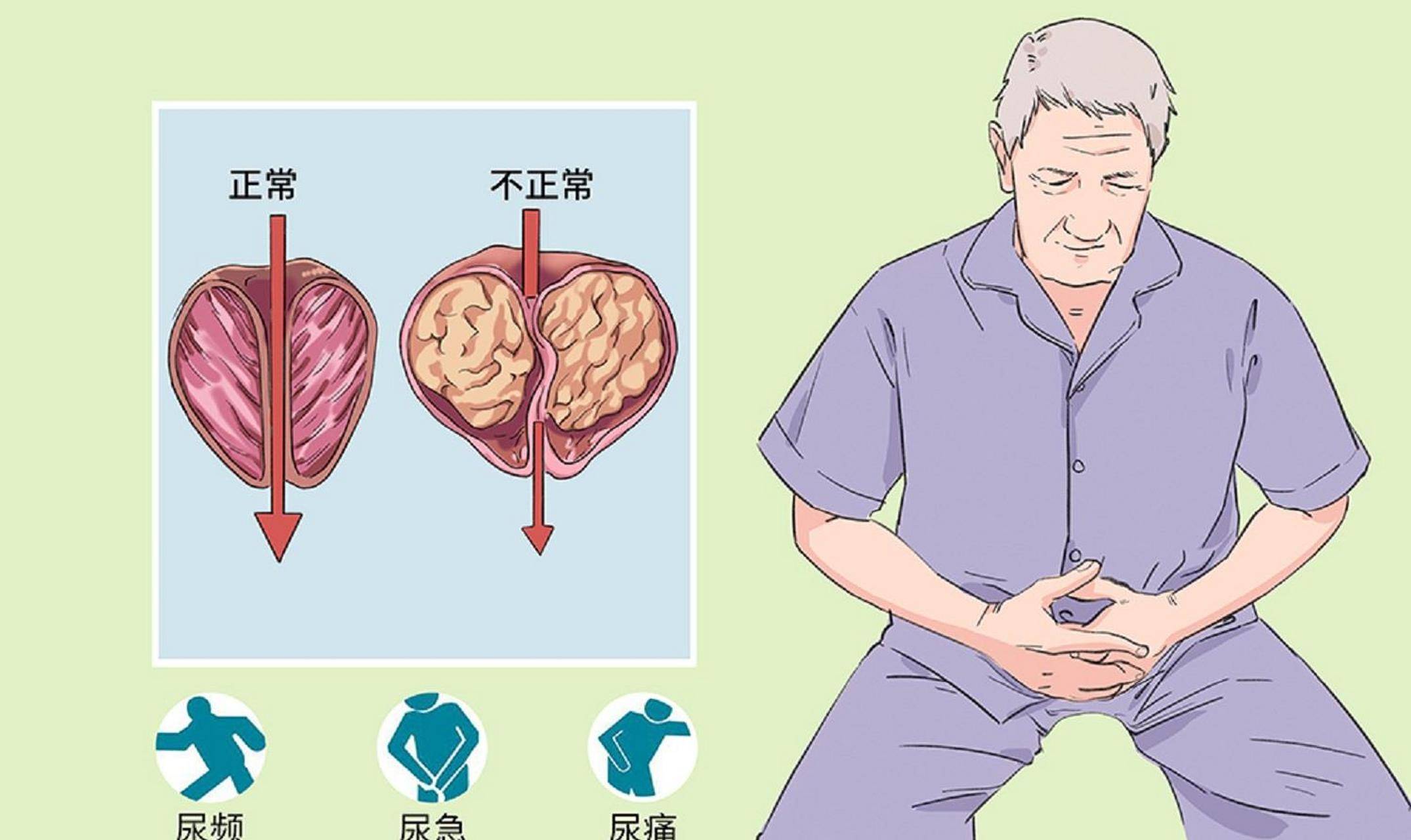 前列腺炎性分泌物图片图片