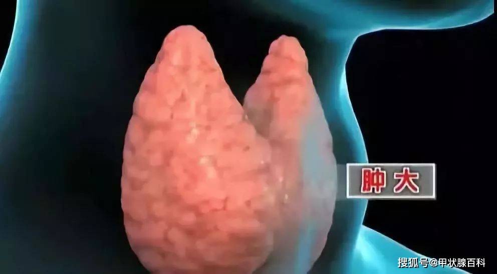 q·"医生,既然甲状腺乳头状癌生存率那么高,那我可不可以直接观察不用