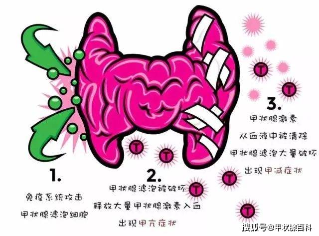 武汉甲康医院刘明澈主任科普甲减已引发9种机体严重异常