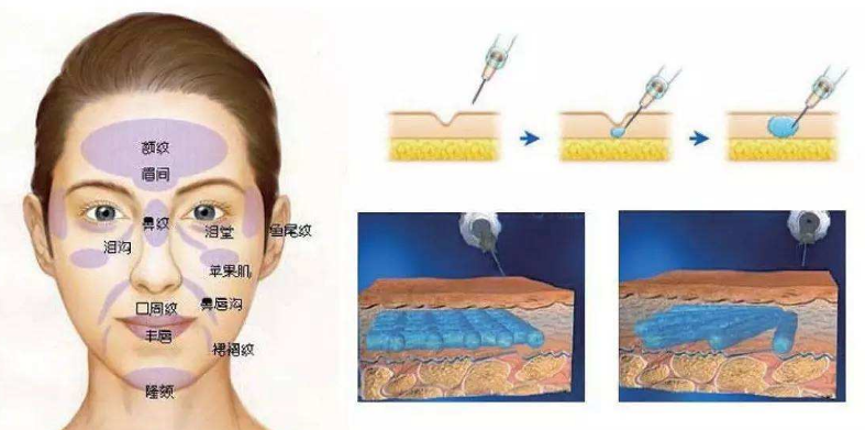 额头除皱针的注射图解图片