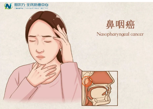 经常流鼻血是鼻咽癌吗