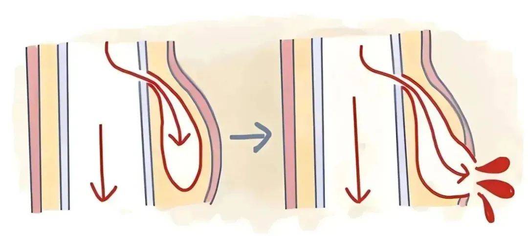 急症救治主动脉夹层破裂介入治疗如何化险为夷