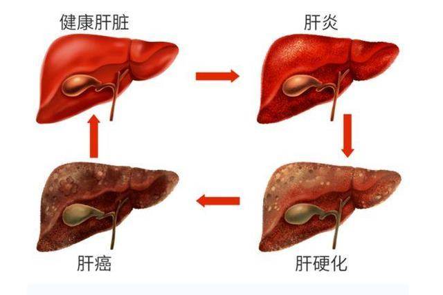 肝硬化能活多久图片