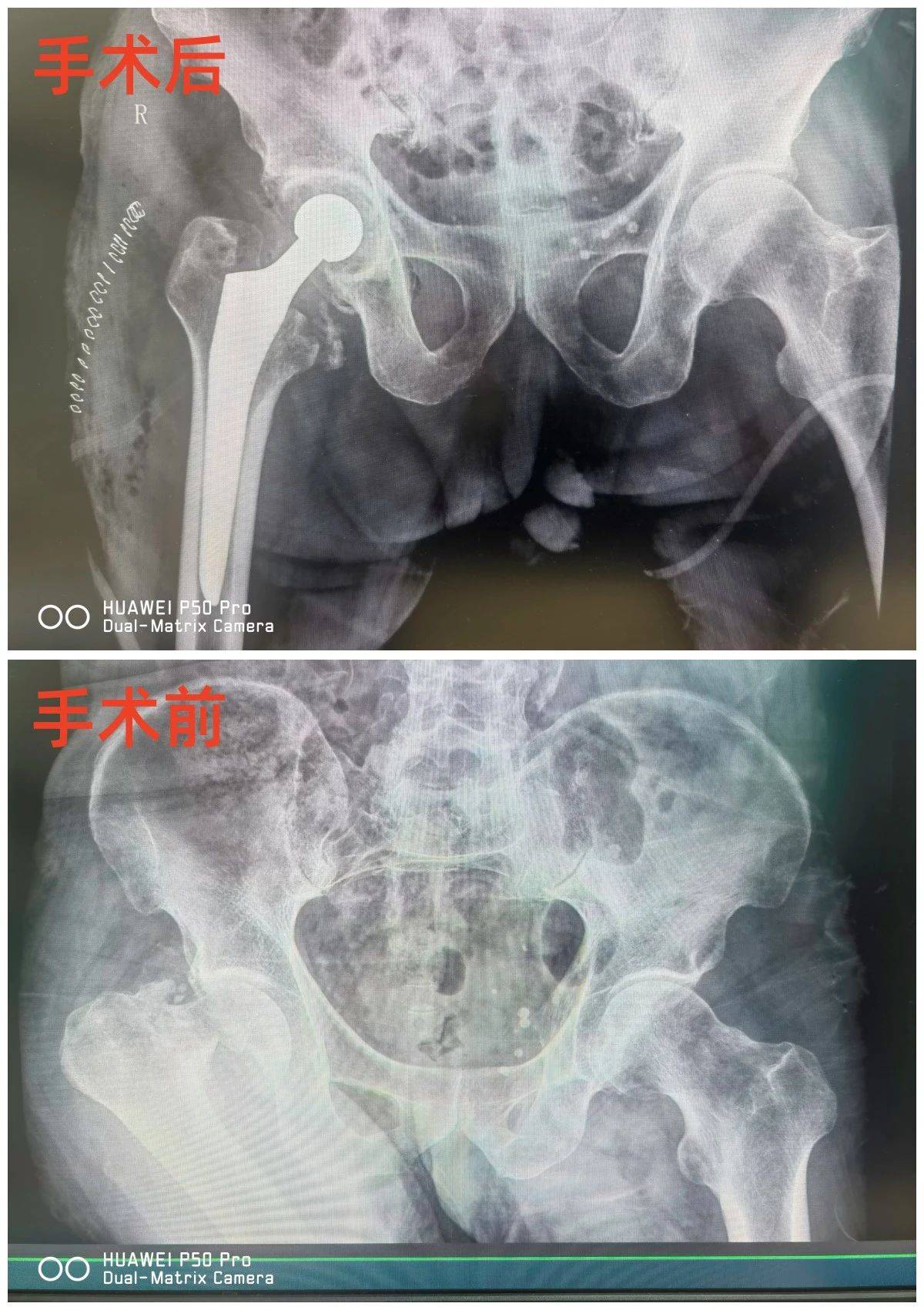 鲁大爷_治疗_股骨颈