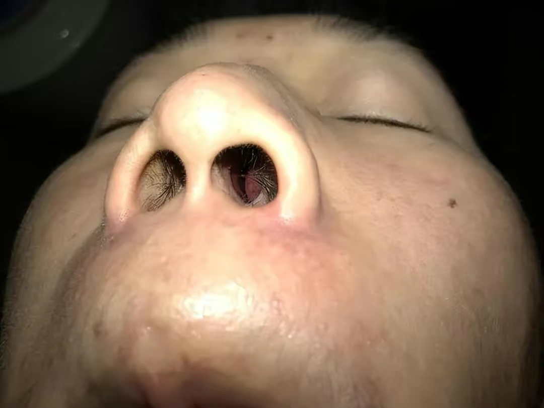 鼻炎必看!简单两步缓解鼻塞流涕!过来人都在用的方法你还不知道