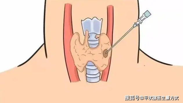 评估甲状腺结节的目的是什么?甲状腺结节治疗方法多,怎么治疗好?_患者