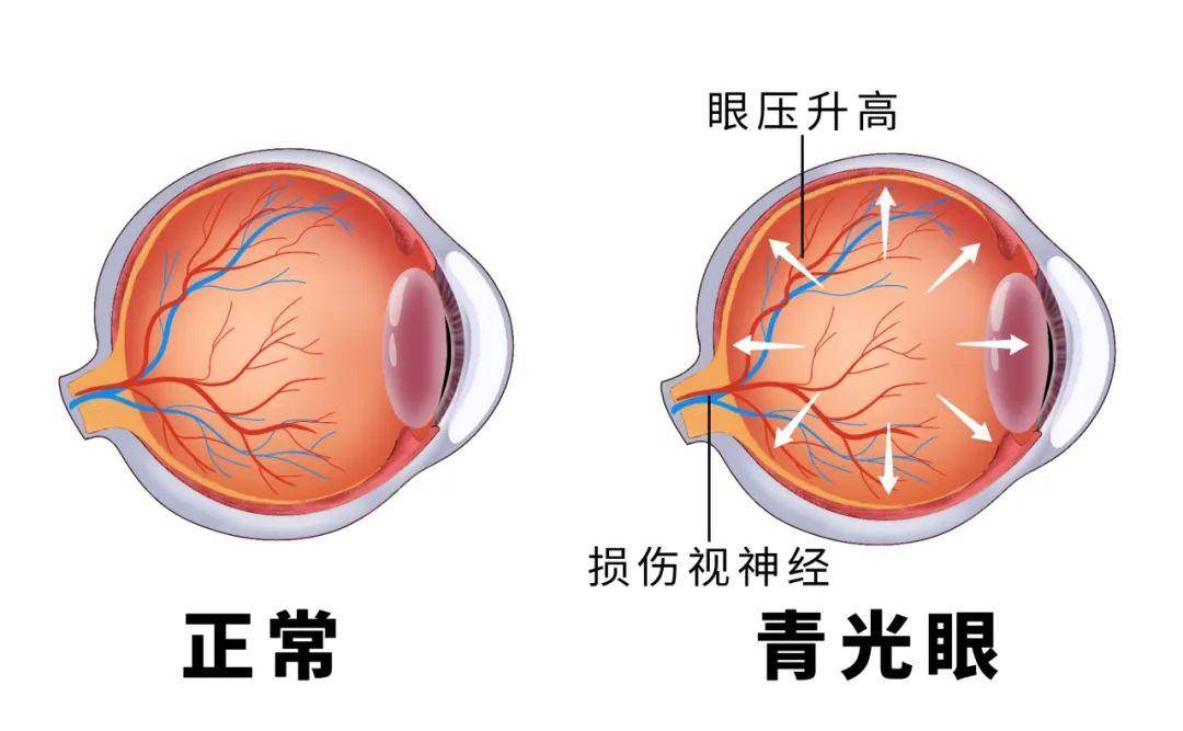 眼科罗明主任眼压高不高摸下眼睛就知道