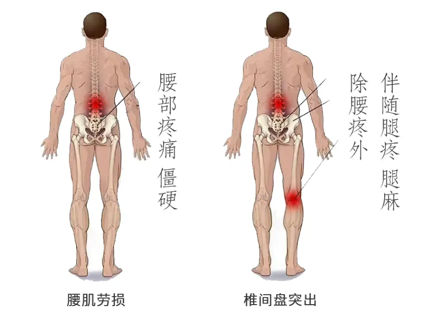 腰肌劳损疼痛位置图图片