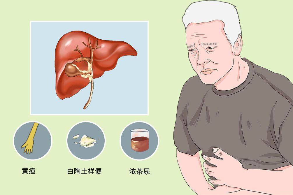 成都普济中医药研究院怎么样肾癌有哪些症状3个信号提示肾癌进入晚期