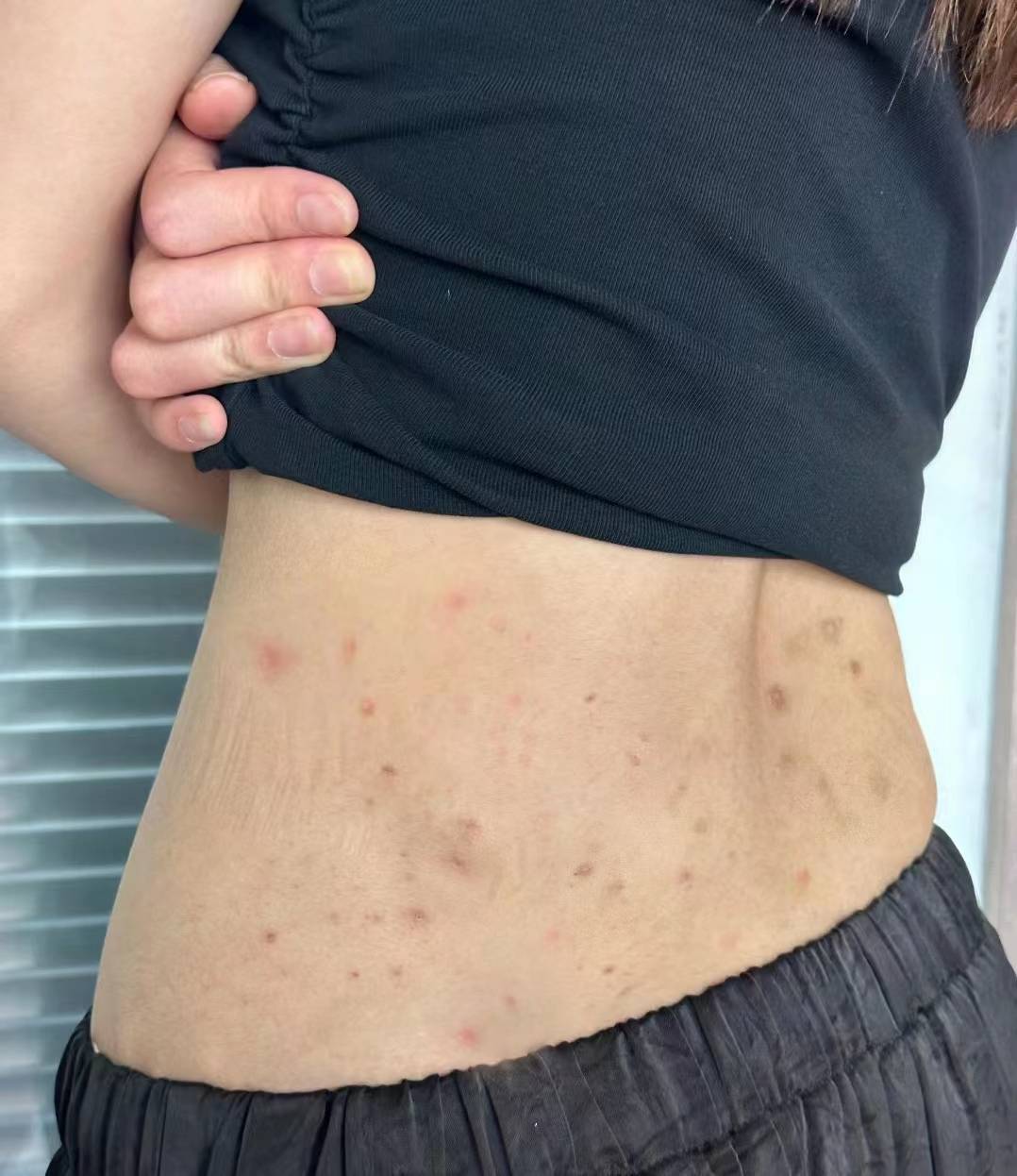 皮肤红疹刺挠要怎么处理过来人3大祛红疹妙招直接用