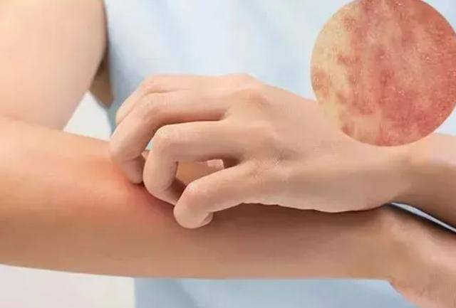 引起了体内的高胆红素血症,致使皮肤发黄之后又出现相应的发痒症状