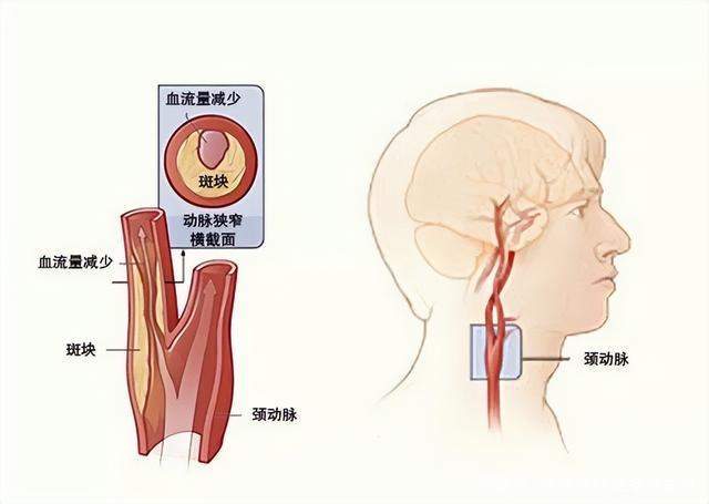 原创不可忽视的颈部隐患颈动脉斑块斑块如何形成如何检测