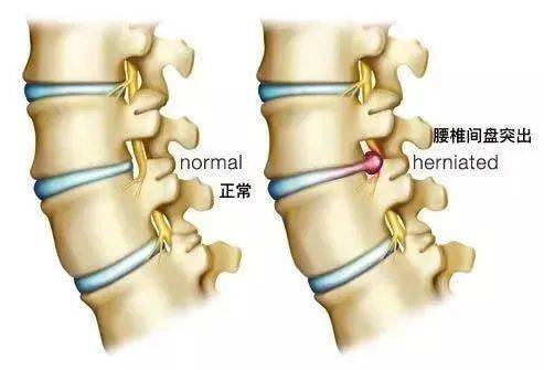 失去原有的固定作用,脊柱生理曲度变直,久而久之造成连接腰椎的椎间盘